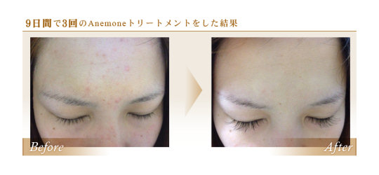 Anemone 3D Ultrasonic Face Cleanser